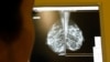 FILE - A doctor exams mammograms, a special type of X-ray of the breasts, which are used to detect tumors, in Nice, France, Jan. 4, 2008.